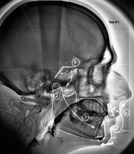 Lire la suite à propos de l’article 28- La base du crâne et les  rétromandibulies