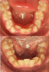 Lire la suite à propos de l’article 33-Faut-il extraire les canines de lait pour faire de la place?