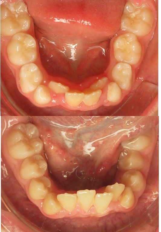 Lire la suite à propos de l’article 33-Faut-il extraire les canines de lait pour faire de la place?