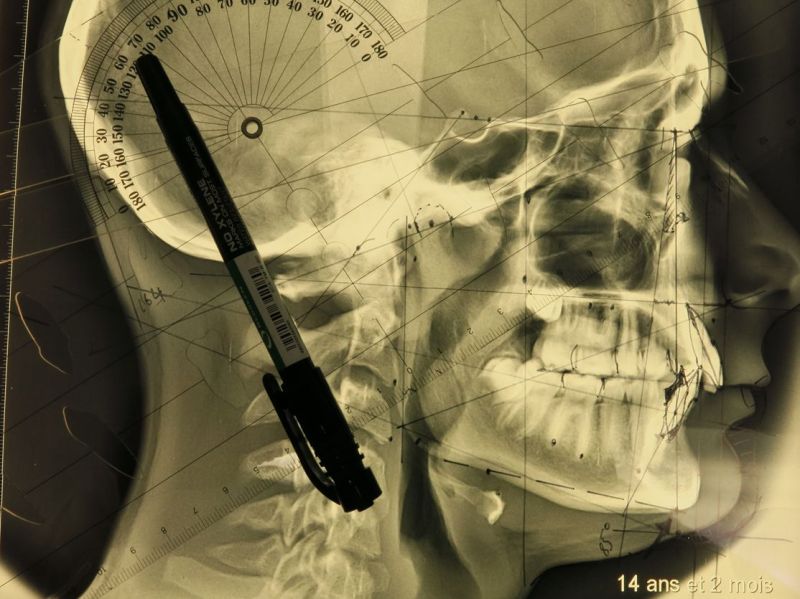 Lire la suite à propos de l’article 35-Céphalométrie 1: Comment comprendre le squelette au quotidien?
