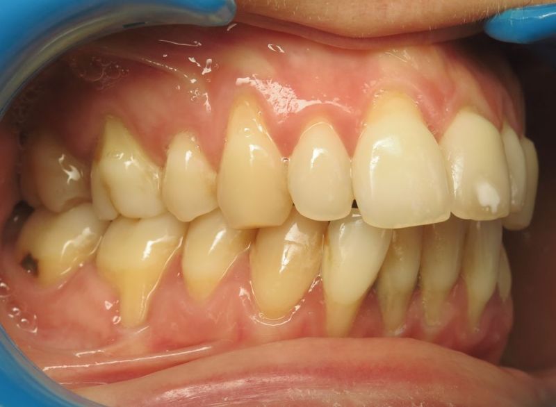 You are currently viewing 37-Peut-on perdre ses dents à cause d’un traitement orthodontique ?