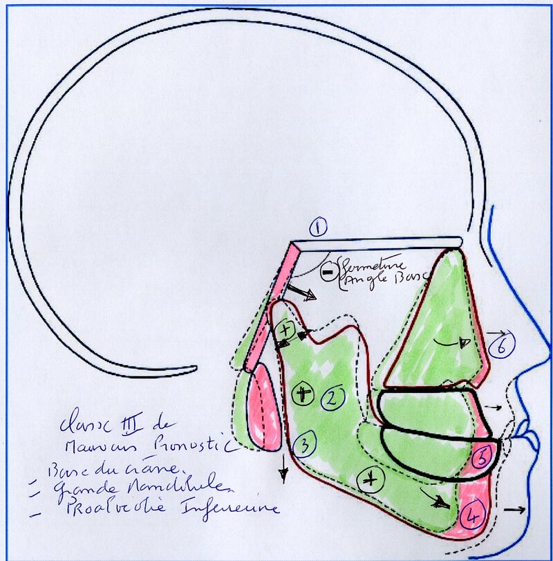 Lire la suite à propos de l’article 43-Y-a-t-il des cas désespérés en orthodontie?