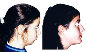 Lire la suite à propos de l’article 51-La chirurgie orthognatique? C&rsquo;est ça.